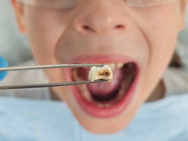 Best Emergency Treatment for Toothache in Fate, TX