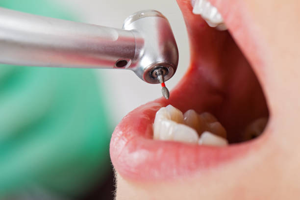 Best Emergency Tooth Extraction in Fate, TX